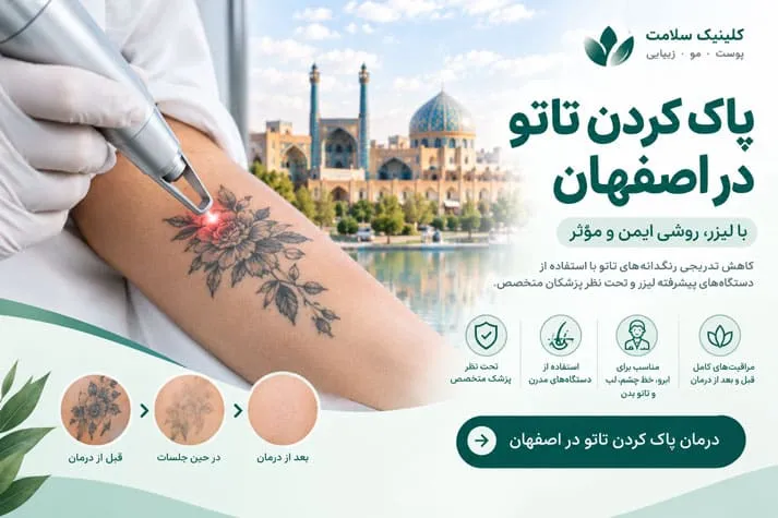 پاک کردت تاتو در اصفهان